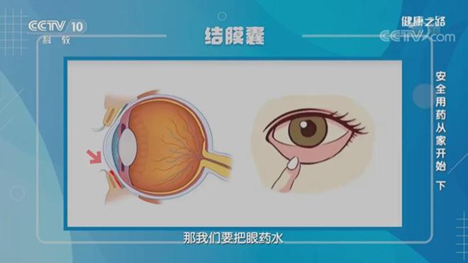 网红眼药水致视力仅剩0.1