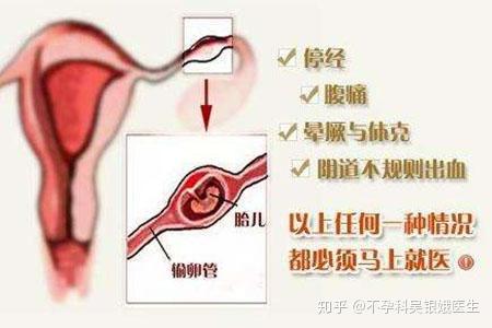 深入了解保仕婷与宫外孕风险，预防策略及几率探讨