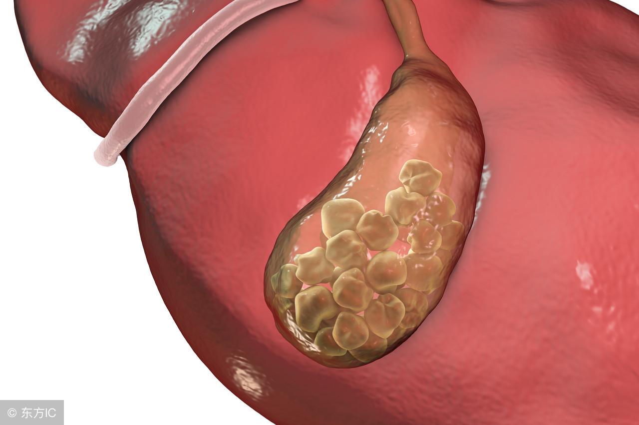 女子胆囊内藏400多颗结石