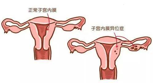 19岁女生每月3周痛经想切子宫，涉政问题的探讨